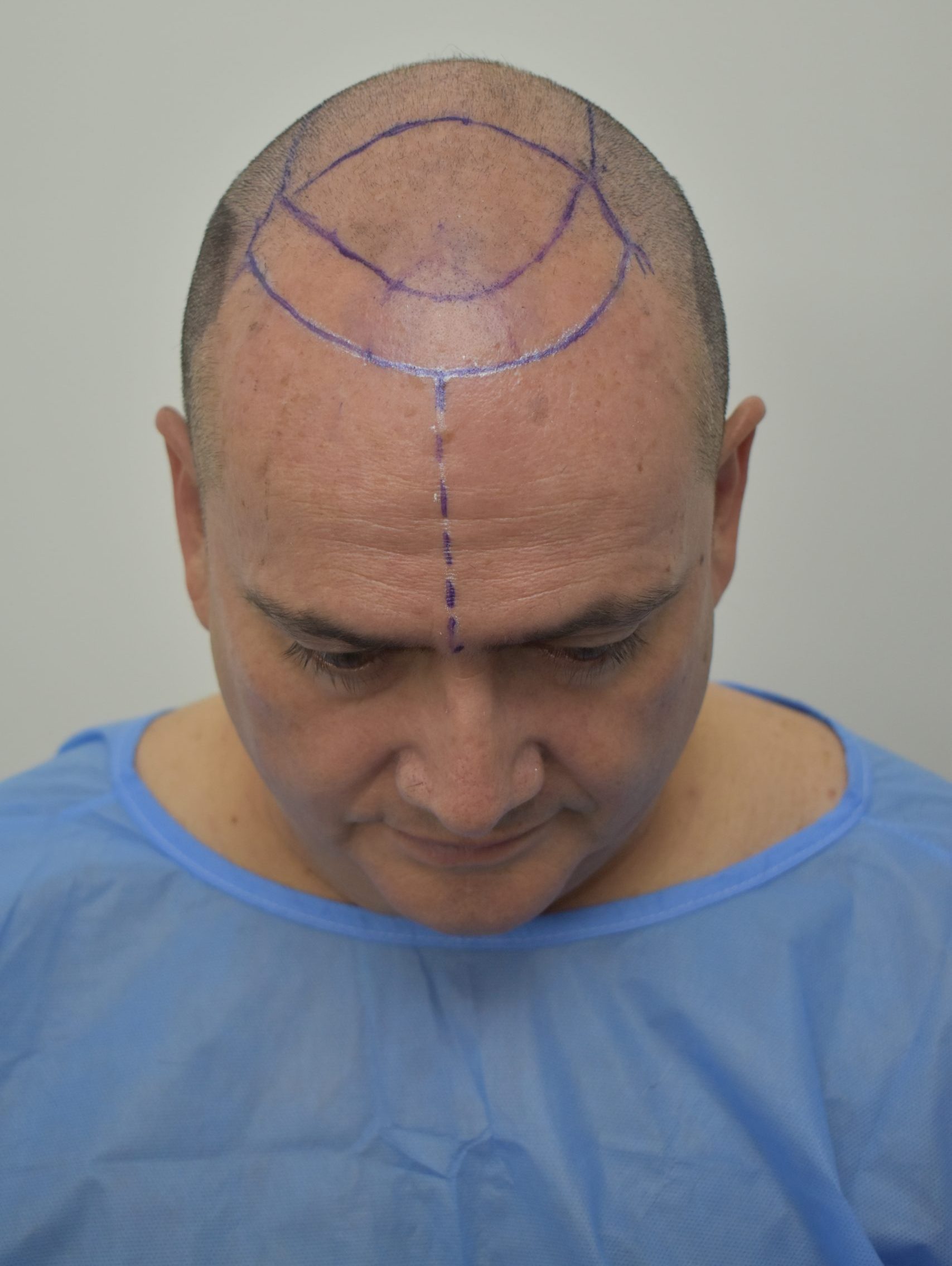 Antes y Despues - Capil Clinic